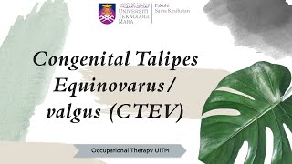 LESSON 8 CONGENITAL TALIPES EQUINOVARUSVALGUS CTEV [upl. by Vernen448]