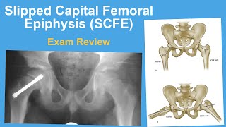 Slipped Capital Femoral Epiphysis Exam Review  Rachel Goldstein MD [upl. by Borer]