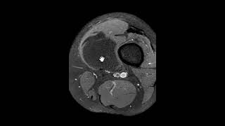 Intramuscular lipoma [upl. by Aihsenod954]