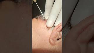 Electrocoagulation of Soft Fibroma on the Scalp [upl. by Palermo]