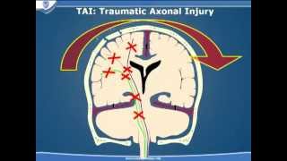 Traumatic Brain Injury  Part 3 [upl. by Aidne]