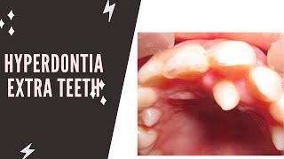 Hyperdontia Extra teeth  supernumerary teeth [upl. by Nodyarg]