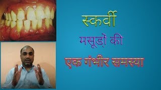 What is scurvyScurvy and Vitamin C  ScurvyTreatment of Scurvy  Symptoms of Scurvy Bleeding Gums [upl. by Edaj]