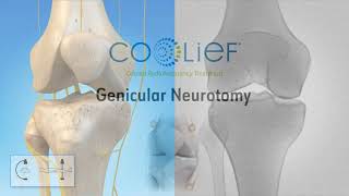 Coolief Knee Cooled RF Animated Video 90D 2 [upl. by Mcconaghy]