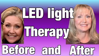 Led light therapy before and after LED skin treatment Antiaging light therapy LED lights [upl. by Ledah]