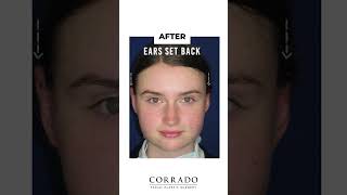 Otoplasty Before and After Pictures – Ear Pinning Surgery  Dr Anthony Corrado [upl. by Gorges]