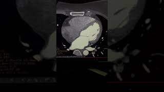 Ct angiography normal report 0 calcium score [upl. by Arihsaj131]