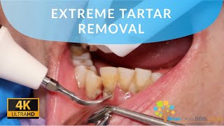 EXTREME TARTAR REMOVAL satisfying dental dentist [upl. by Liagiba706]