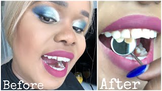 Fix Chipped Tooth at Home during Quarantine [upl. by Ailati426]