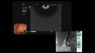 EUS guided Biliary Drainage Rendezvous [upl. by Bond]