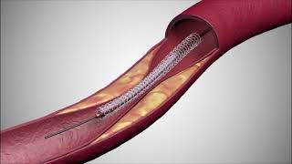 Animatie implantare de stent  Dr Pretorian  Spital Medicover  tel 0376448869 [upl. by Haslam247]