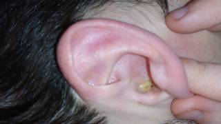 Melting earwax with Otex [upl. by Rahman]