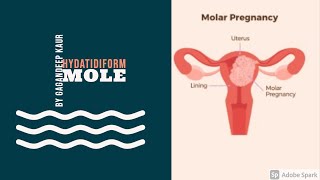 HYDATIDIFORM MOLE Unit7 OBG HIGH RISK PREGNANCY [upl. by Euginom]