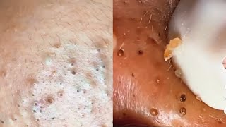 Acne treatment  satisfying blackheads and pimples compilation p51 [upl. by Oca592]