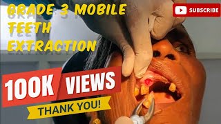 Quick and Painless Extracting Grade 3 Mobile Teeth with Ease viralvideo youtubevideo dental [upl. by Juliana574]