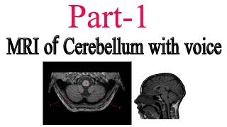 MRI cerebellum and definition part 1 [upl. by Eltsyrk242]