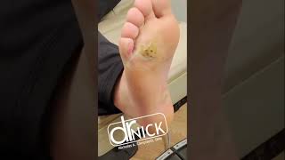 How to treat PLANTAR WARTS shorts [upl. by Irovi297]