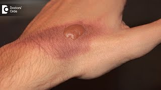 How to treat a burn blister at home Tips to avoid burn scar  Dr Pavan Murdeshwar [upl. by Llebiram694]