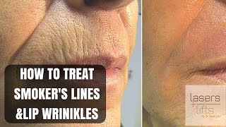 How to treat upper lip wrinkles and smokers lines [upl. by Sidra]