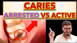 How to Differentiate between Arrested and Active CARIES Clinical Cases caries removal ICDAS [upl. by Jari]