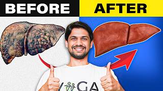 STOP Fatty Liver Disease Naturally  5 Daily Habits for Liver Health  Saurabh Bothra [upl. by Nnewg]