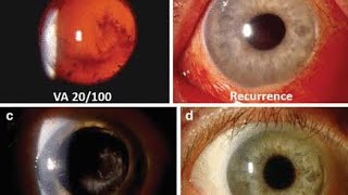 Endophthalmitis Diagnosis Clinical Approach [upl. by Ohploda]