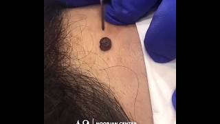 mole removal with Plasmage ®  by noorjan center [upl. by Adine]