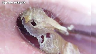 Ear Wax Removal 124 This Is My First Time Getting My Ears Cleaned  Ear Cleaning ASMR [upl. by Ummersen]