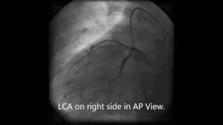 Situs Inversus Dextrocardia [upl. by Alleuqram]