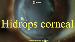 Hidrops Corneal [upl. by Asserac]