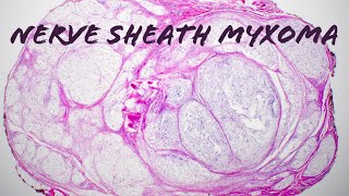 Nerve sheath myxoma with Verocay palisading formerly myxoid neurothekeoma pathology dermpath [upl. by Sansbury]