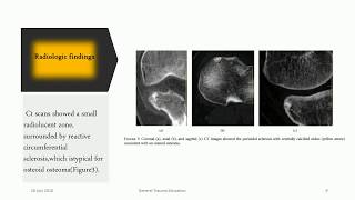 Osteoid Osteoma [upl. by Leakcim302]