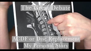 ACDF vs Disc Replacement  Cervical Fusion or Arthroplasty  My Presurgery story [upl. by Datha]