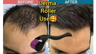 How Many Times Derma Roller can be used  Derma Roller Hair Regrowth  Microneedle At Home [upl. by Iadam643]