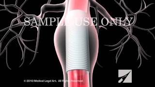 Abdominal Aortic Aneurysm [upl. by Yticilef]