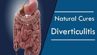 How to Treat Diverticulitis Naturally at Home [upl. by Toy]