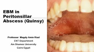 EBM in Peritonsillar Abscess Quinsy [upl. by Aihsrop]