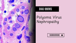 Polyoma virus nephropathy [upl. by Annoerb84]