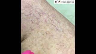 Sclerotherapy  Get Rid of Spider Veins [upl. by Atikam417]