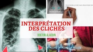 Pneumopathie Interstitielle Diffuse  Maitriser linterprétation des clichés [upl. by Oicram]