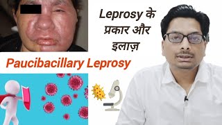 Paucibacillary Leprosy  Leprosy के प्रकार और इलाज़  नसों को नुकसान पहुंचाने वाली कुष्ट रोग leprosy [upl. by Adamsen777]