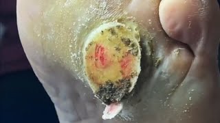 Pedicure video22，vertical plantaris，plantar wart [upl. by Enytnoel]