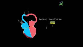 ACS MR Teaser usmle internalmedicine coronary [upl. by Nazario]