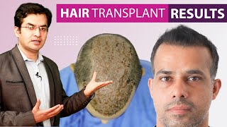 Hair Transplant Before and After Results Grade 6  5000 Grafts at Medispa  Dr Suneet Soni [upl. by Irehc]