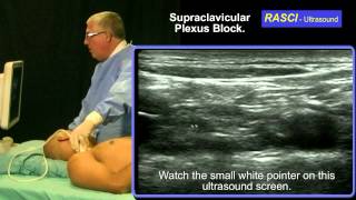 Ultrasound guided Supraclavicular plexus block [upl. by Nabatse915]