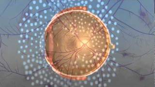 Vitrectomy Surgery for Diabetic Retinopathy [upl. by Selij]