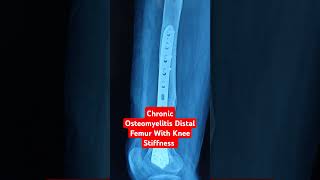 Chronic Osteomyelitis Distal Femur With Knee Stiffness Dr Sai Chandra [upl. by Sidwel]