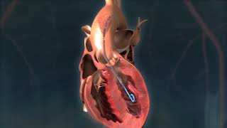 Impella CP® Heart Pump Animation [upl. by Ecnarrat]