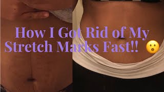 How I got rid of my stretch marks fast [upl. by Dupre]