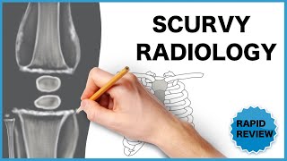 Scurvy Radiological Findings [upl. by Ranjiv]